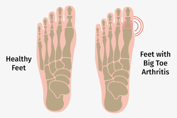 causes behind big toe arthritis