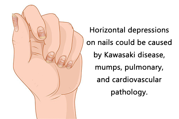 horizontal depressions on nails
