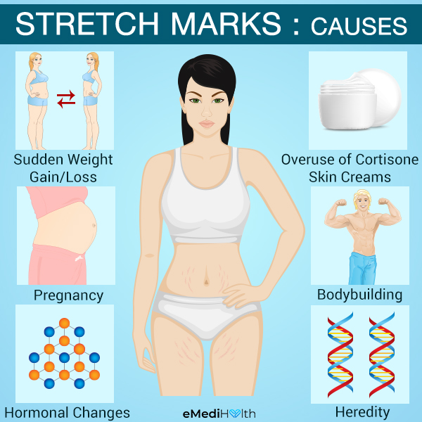 what causes stretch marks?