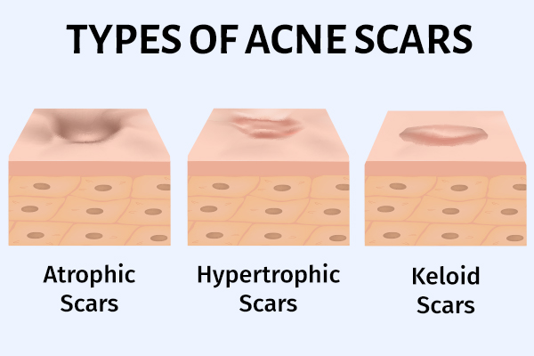 types of acne scars