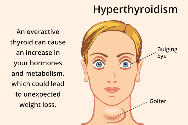 an overactive thyroid can cause unexpected weight loss