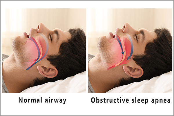 obstructive sleep apnea