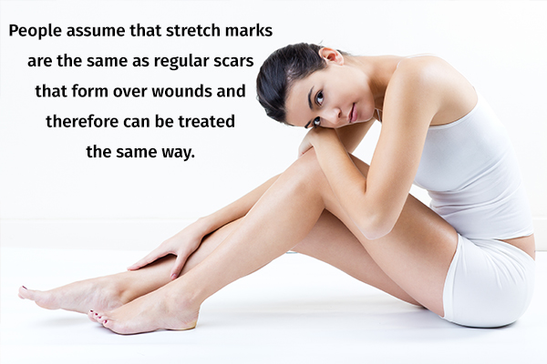 stretch marks can be eliminated completely
