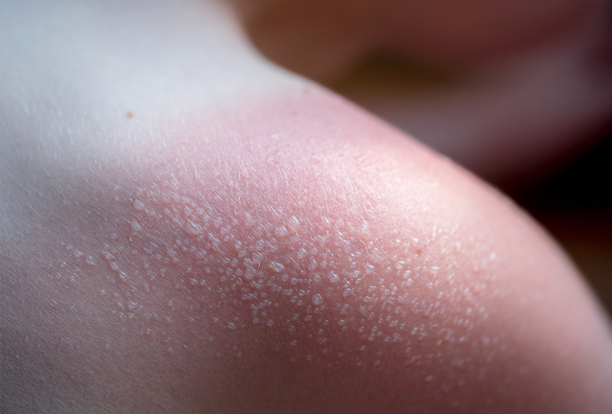 managing sunburn blisters