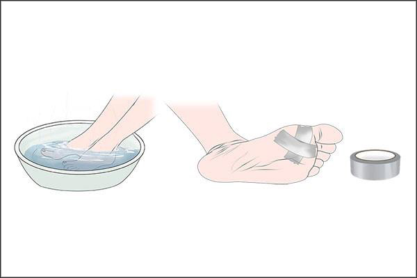 plantar wart duct tape before after