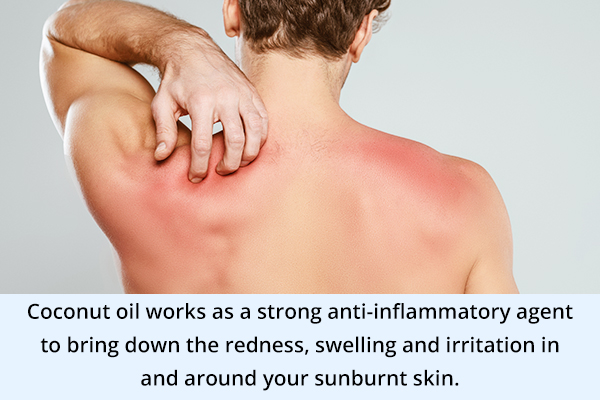 coconut oil can help soothe your sunburnt skin