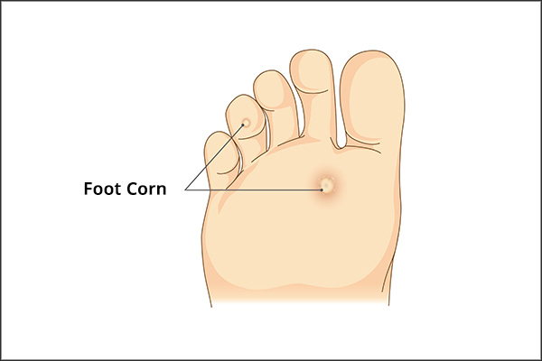 differentiating between warts and foot corns