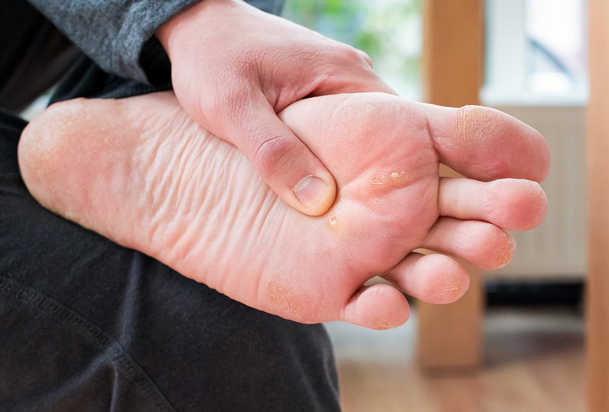solutions for plantar warts