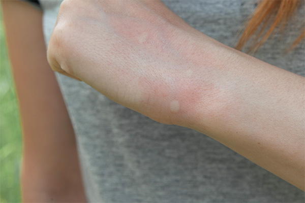 stages and symptoms of lyme disease