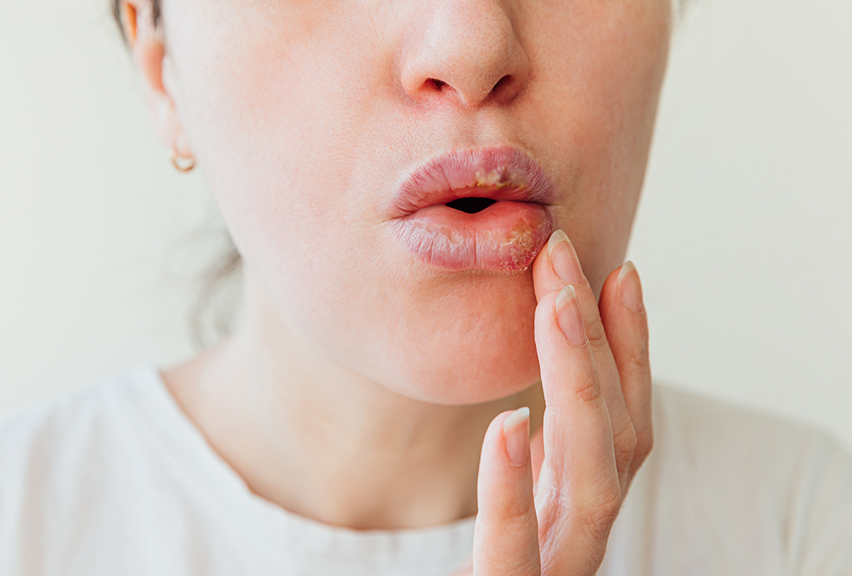 swollen lips remedies