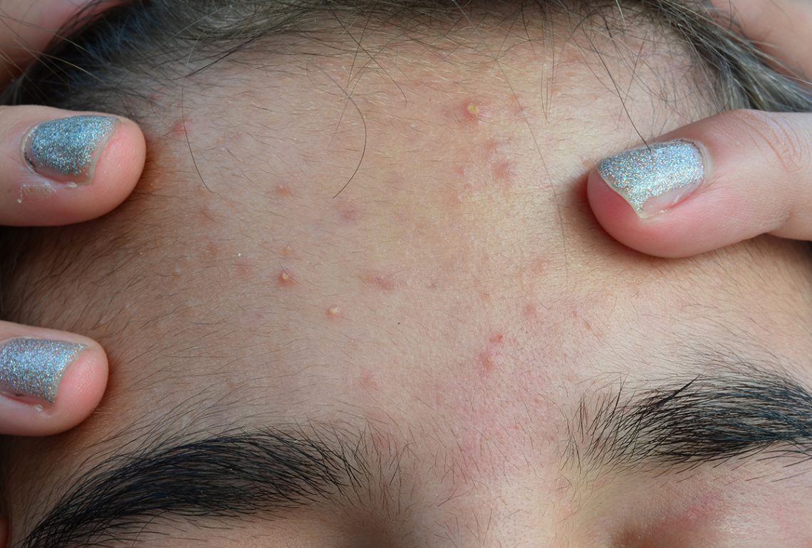 tiny-bumps-on-forehead-small-pimples-small-bumps-on-f-vrogue-co