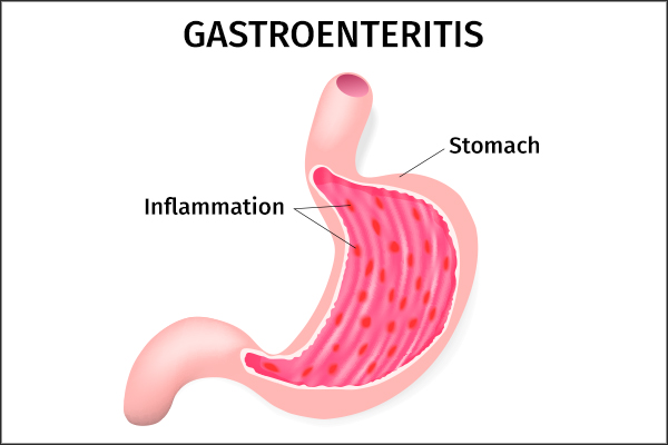 causes behind gastroenteritis