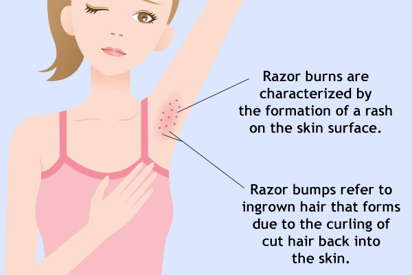 razor burns vs. razor bumps