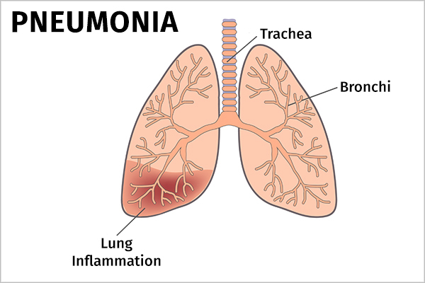 types of pneumonia