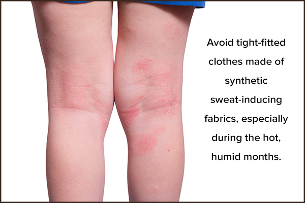 tips to prevent ringworm in children