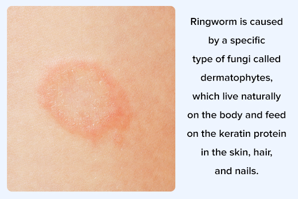 Ringworm on skin