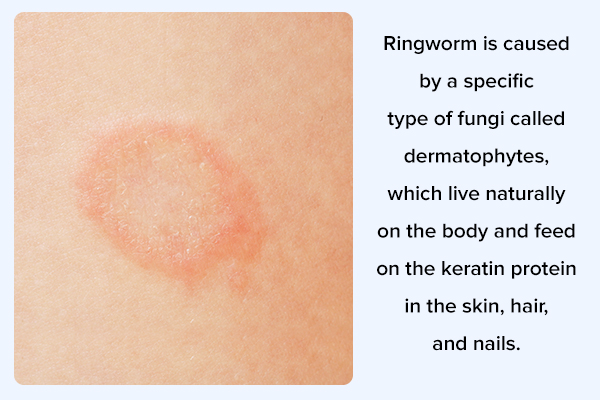 Ringworm on Tattoo: Symptoms and Causes - wide 7