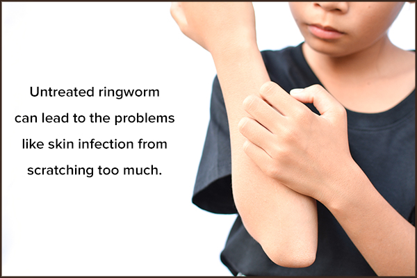 complications of untreated ringworm in children