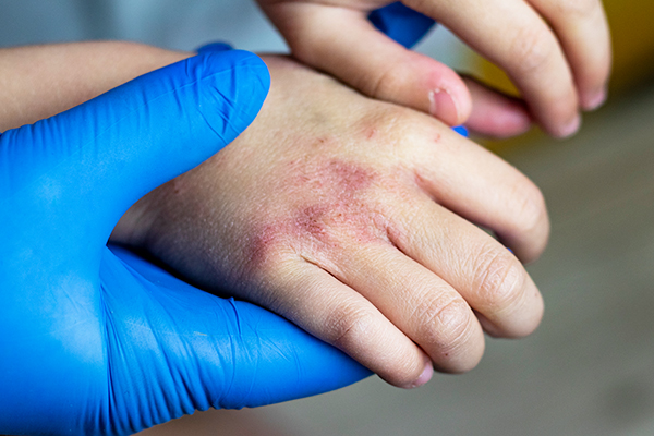 diagnosing ringworm in children