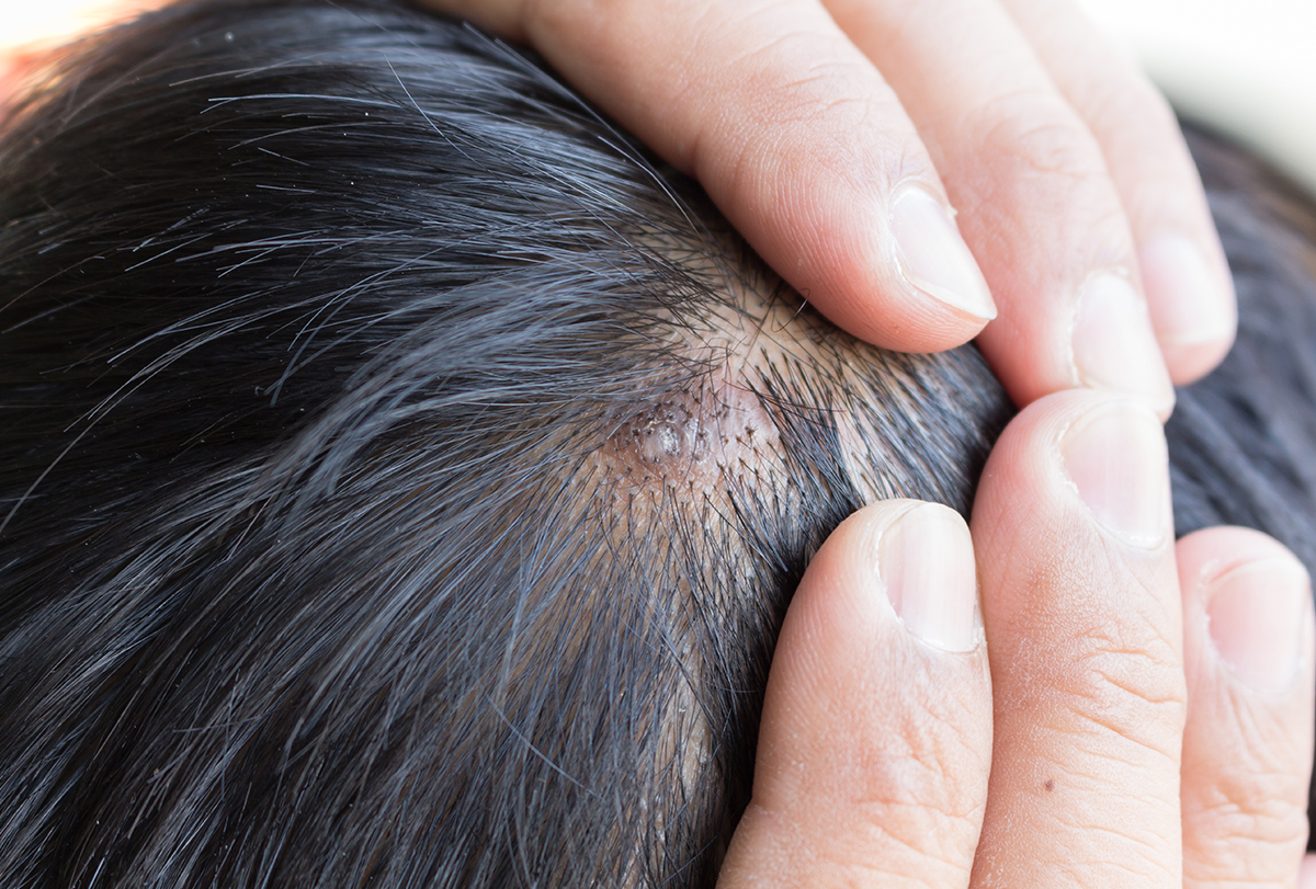 white-spots-on-scalp