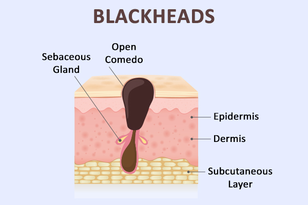 formation of blackheads in ears