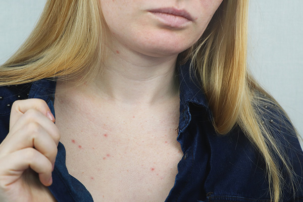 complications associated with chest acne