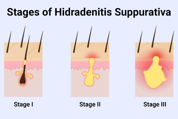 different stages of hidradenitis suppurativa