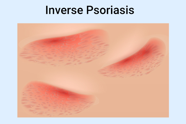inverse psoriasis symptoms