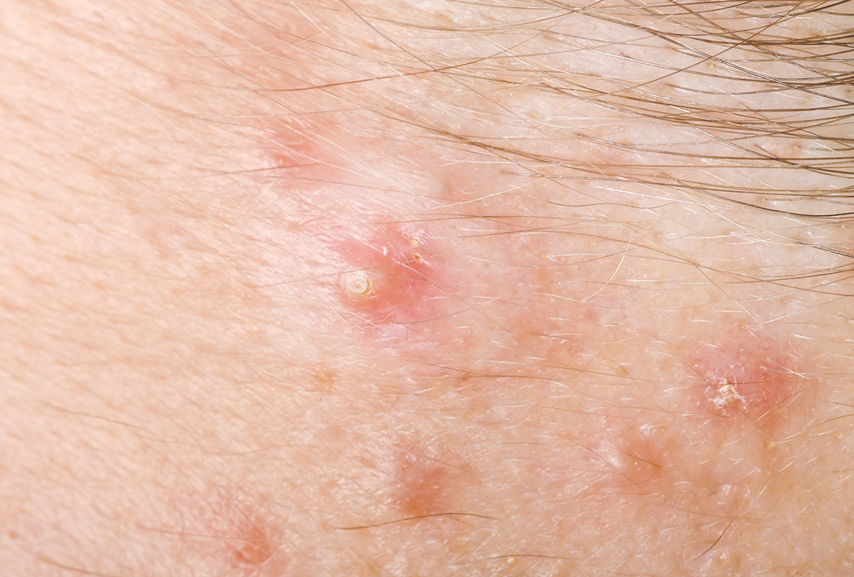 How To Treat Hidradenitis Suppurativa Emedihealth