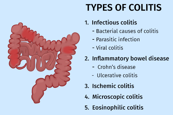 types of colitis and their causes