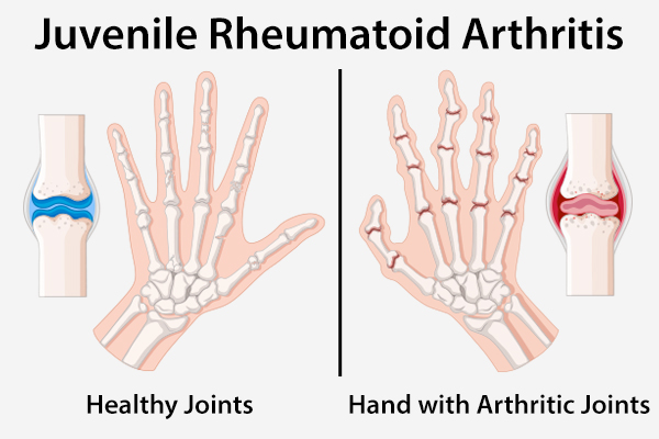types of juvenile rheumatoid arthritis