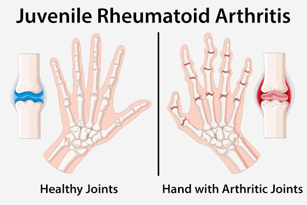 Types Of Juvenile Rheumatoid Arthritis 