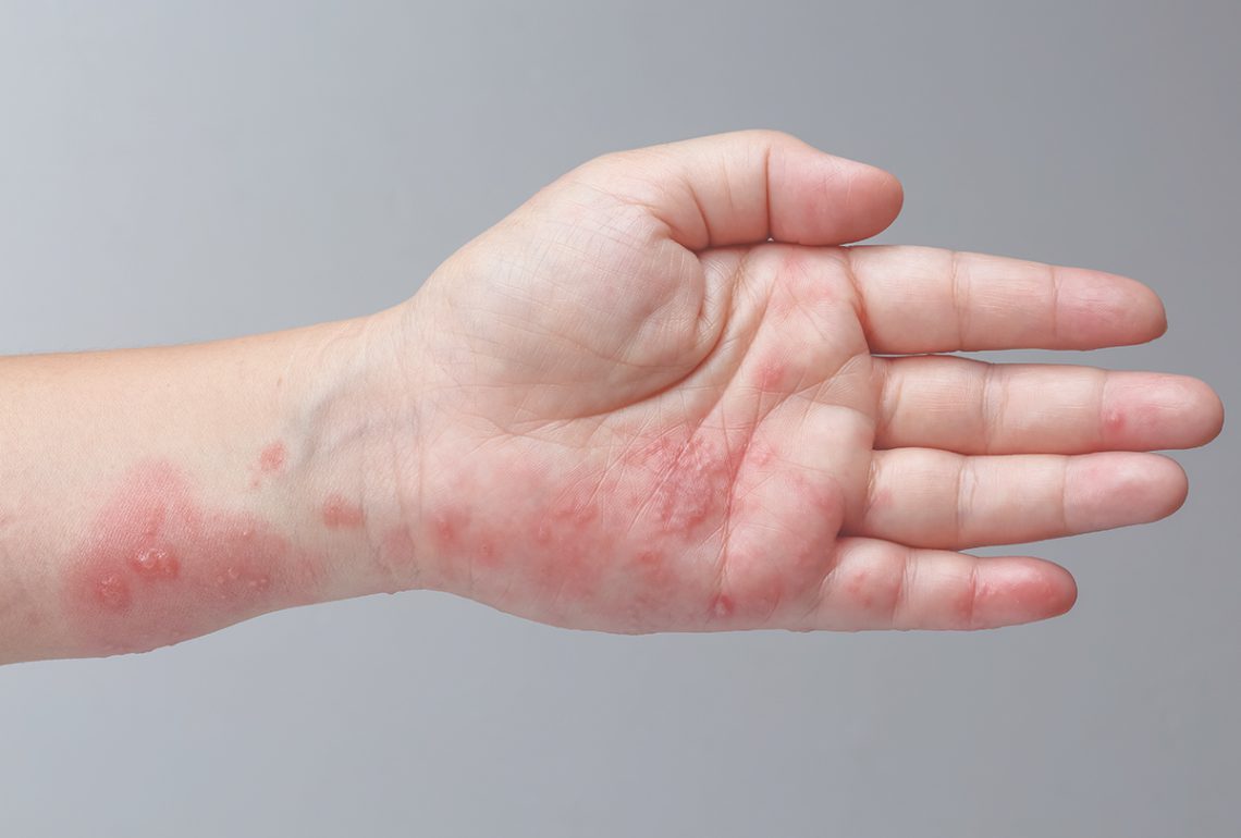 Scabies Causes Symptoms Treatment And Complications