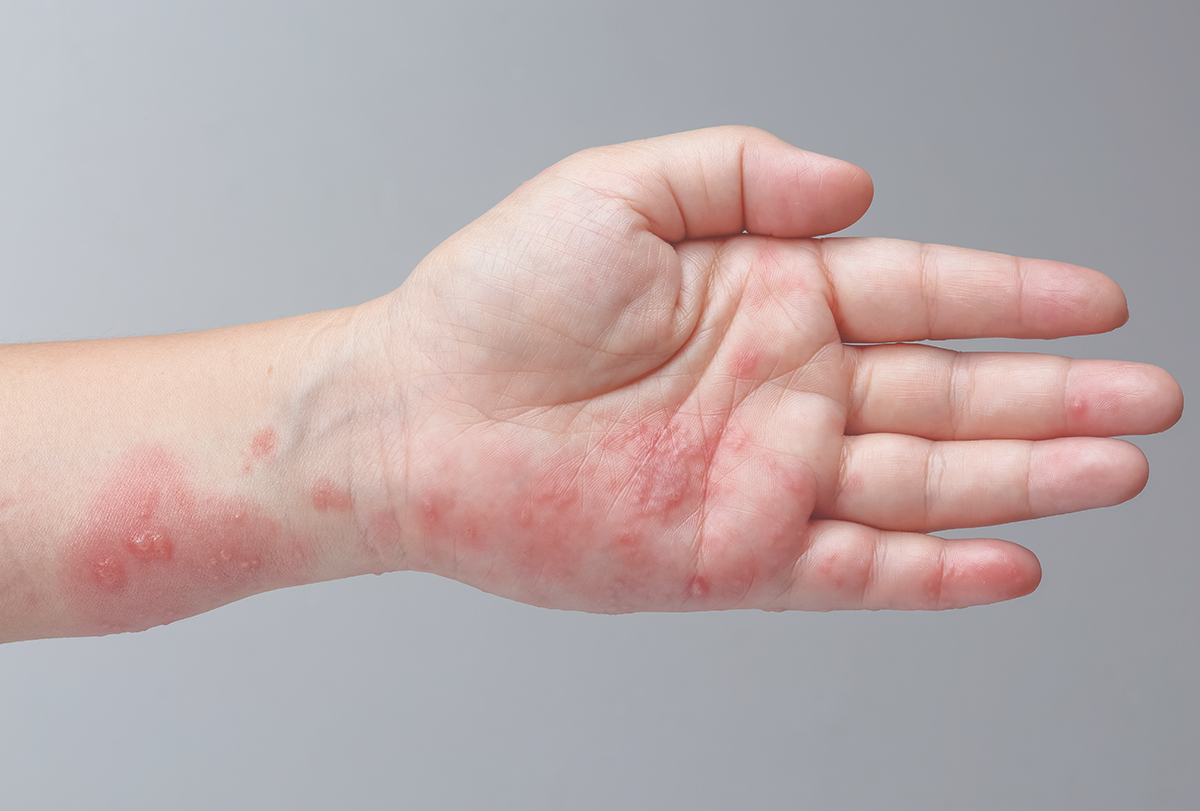 scabies symptoms and causes