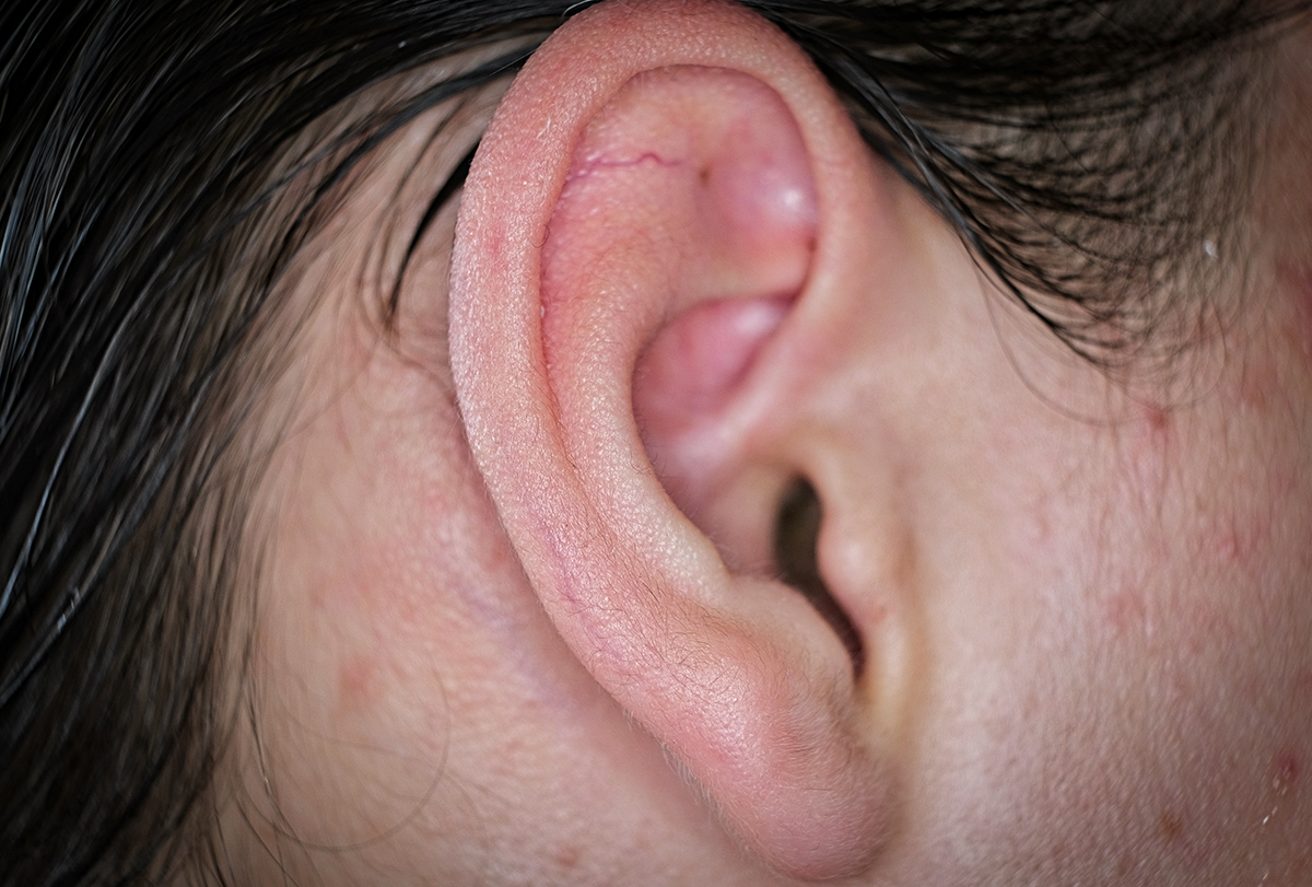 Zits In Ear