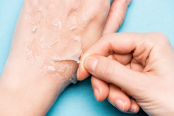 using hand peels can help fade hand wrinkles