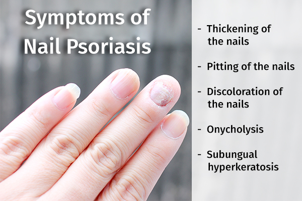 psoriasis on fingernails