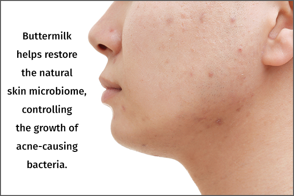 buttermilk can help control and manage pimples