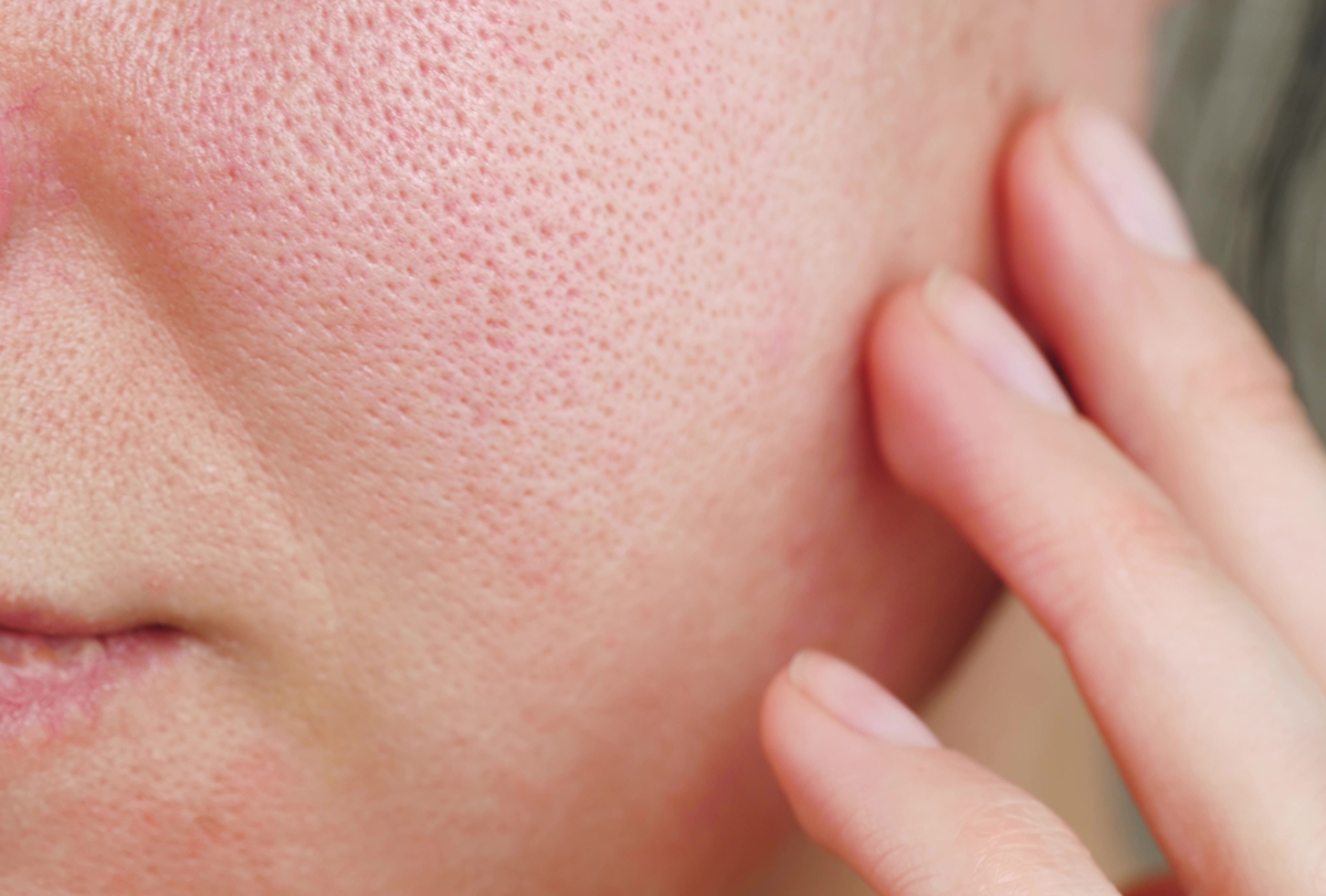 perioral dermatitis causes and treatment