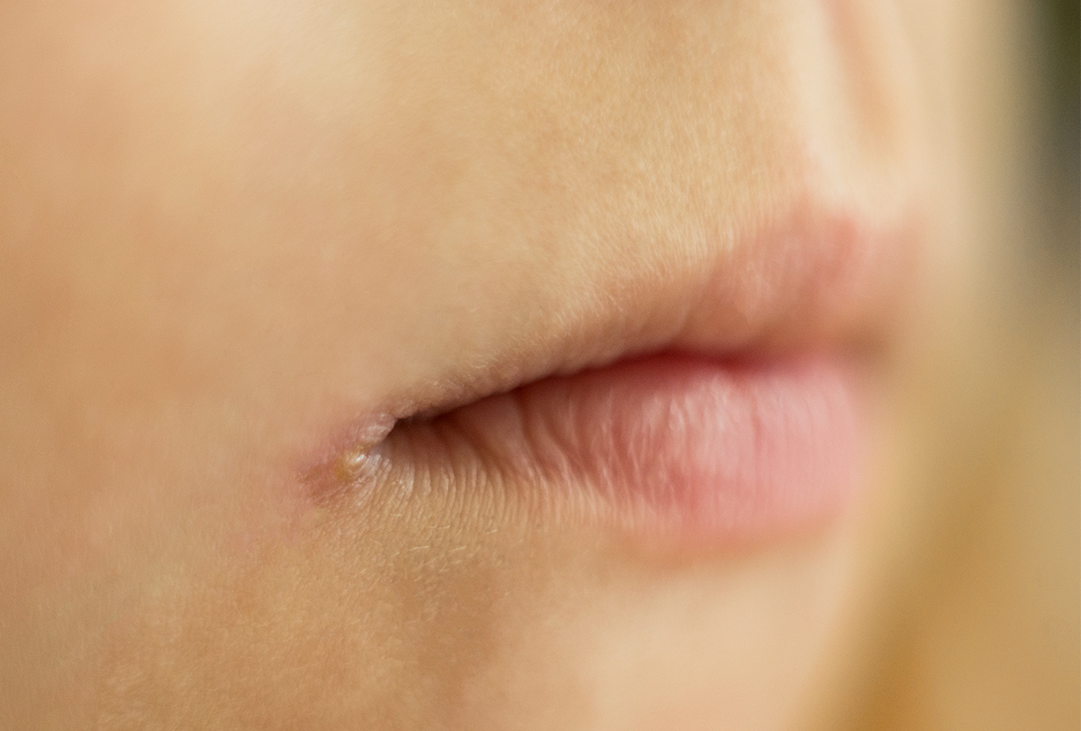 angular cheilitis or cold sore