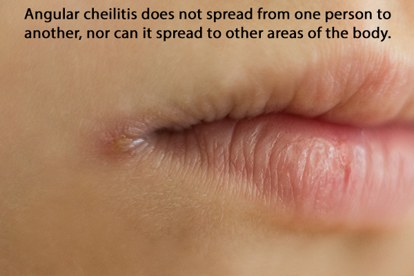 is angular cheilitis a communicable disease?