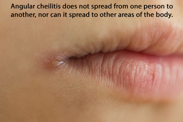 How To Treat Angular Cheilitis On Lips | Lipstutorial.org