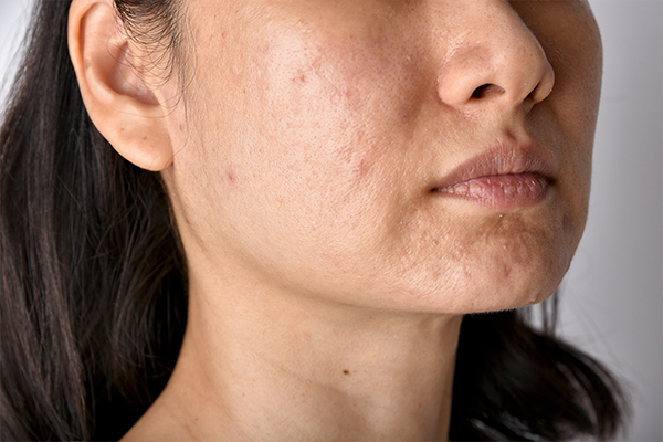 solutions for pimple redness