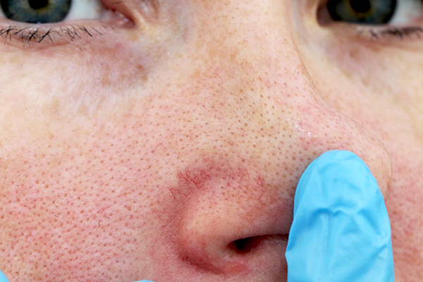 contact your doctor for rosacea