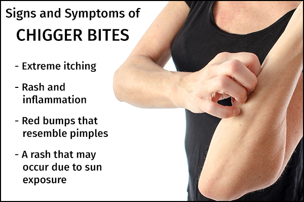 signs, symptoms of chigger bites