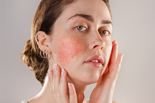 a butterfly-shaped rash on the face could be indicative of lupus