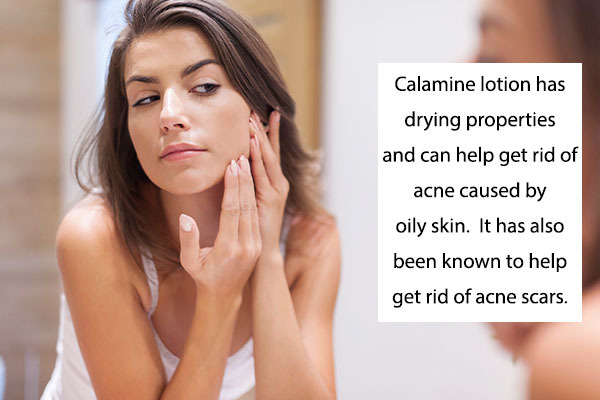 calamine lotion can help soothe acne and acne scars