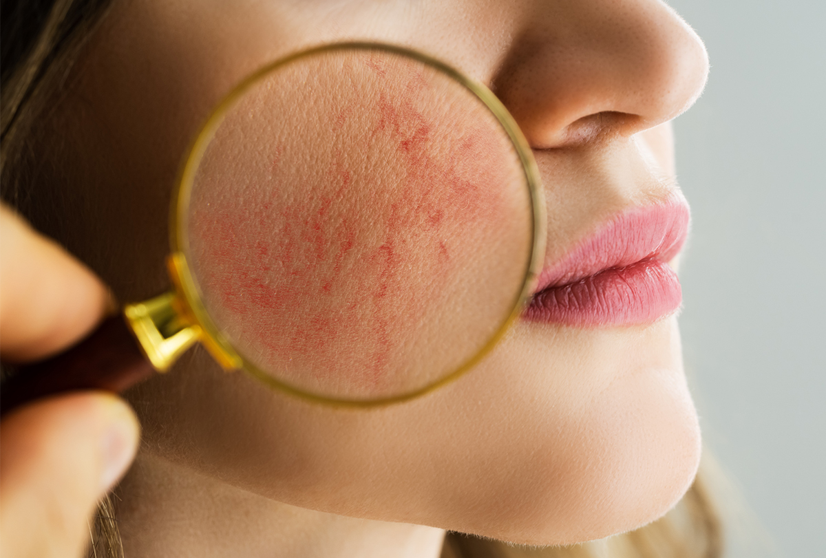 broken capillaries on face: causes and treatment