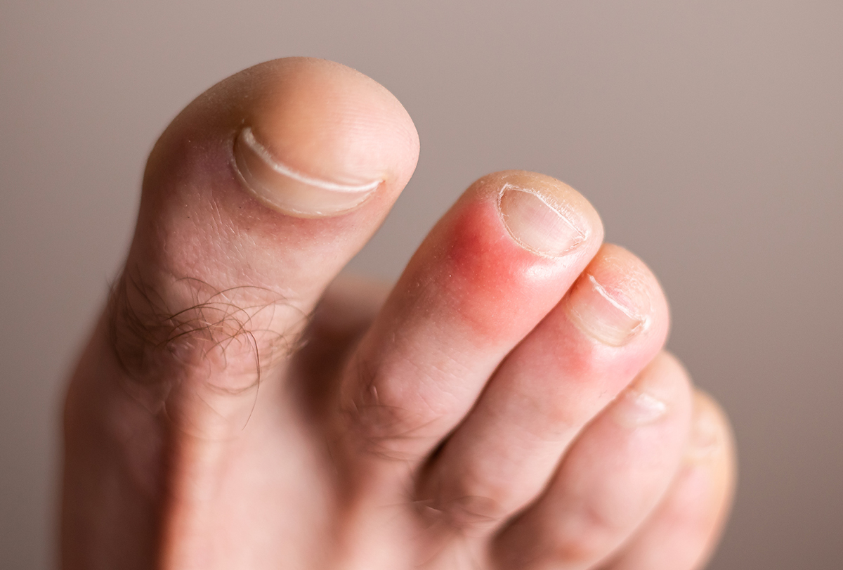 chilblains: causes and treatment