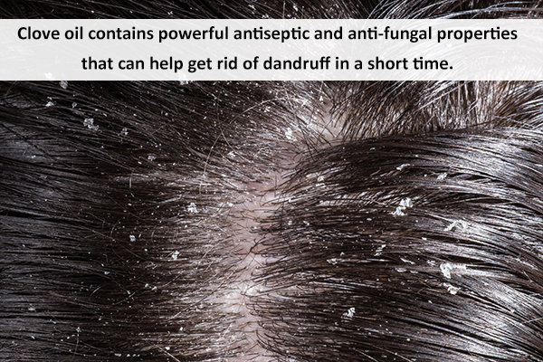 clove benefits your hair health and reduces dandruff